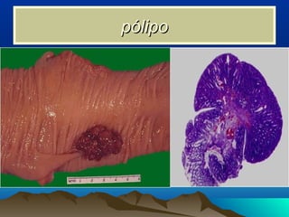 pólipopólipo
 