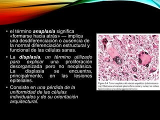 • el término anaplasia significa
«formarse hacia atrás» — implica
una desdiferenciación o ausencia de
la normal diferenciación estructural y
funcional de las células sanas.
• La displasia, un término utilizado
para explicar una proliferación
desorganizada pero no neoplásica.
La displasia se encuentra,
principalmente, en las lesiones
epiteliales.
• Consiste en una pérdida de la
uniformidad de las células
individuales y de su orientación
arquitectural.
 