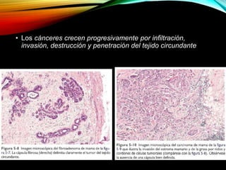 • Los cánceres crecen progresivamente por infiltración,
invasión, destrucción y penetración del tejido circundante
 