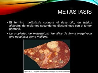 METÁSTASIS
• El término metástasis connota el desarrollo, en tejidos
alejados, de implantes secundarios discontinuos con el tumor
primario.
• La propiedad de metastatizar identifica de forma inequívoca
una neoplasia como maligna.
 