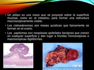 • Un pólipo es una masa que se proyecta sobre la superficie
mucosa, como en el intestino, para formar una estructura
macroscópicamente visible.
• Los cistoadenomas son masas quísticas que típicamente se
forman en el ovario.
• Los papilomas son neoplasias epiteliales benignas que crecen
en cualquier superficie y dan lugar a frondas microscópicas o
macroscópicas digitiformes.
 