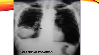 CARCINOMA ESCAMOSO
 