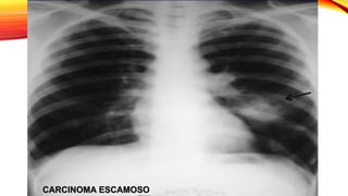 CARCINOMA ESCAMOSO
 