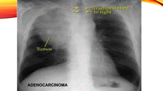 ADENOCARCINOMA
 