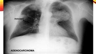ADENOCARCINOMA
Atelectasia
 