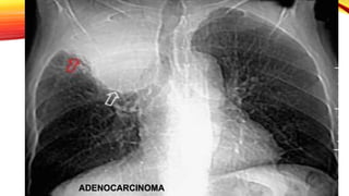 ADENOCARCINOMA
 