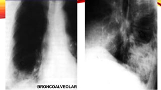 BRONCOALVEOLAR
 