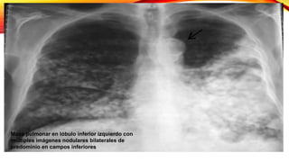 Masa pulmonar en lóbulo inferior izquierdo con
múltiples imágenes nodulares bilaterales de
predominio en campos inferiores
 