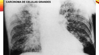 CARCINOMA DE CELULAS GRANDES
 