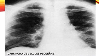 CARCINOMA DE CELULAS PEQUEÑAS
 