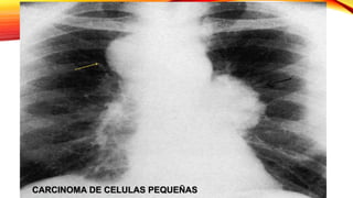 CARCINOMA DE CELULAS PEQUEÑAS
 