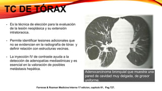 TC DE TÓRAX
- Es la técnica de elección para la evaluación
de la lesión neoplásica y su extensión
intratoracica.
- Permite identificar lesiones adicionales que
no se evidencian en la radiografía de tórax y
definir relación con estructuras vecinas.
- La inyección IV de contraste ayuda a la
detección de adenopatías mediastinicas y es
esencial en la valoración de posibles
metástasis hepática.
Farreras & Rozman Medicina Interna 17 edicion, capitulo 81, Pag 727.
 