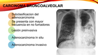 CARCINOMA BRONCOALVEOLAR
Subclasificacion del
adenocarcinoma
Se presenta con mayor
frecuencia en no fumadores
Lesión preinvasiva
Adenocarcinoma in situ
Adenocarcinoma invasivo
 