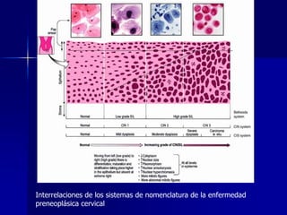 Interrelaciones de los sistemas de nomenclatura de la enfermedad
preneoplásica cervical
 