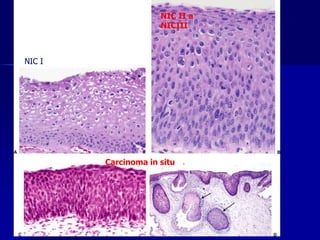 NIC I
NIC II a
NICIII
Carcinoma in situ
 