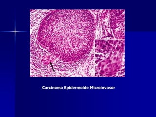 Carcinoma Epidermoide Microinvasor
 