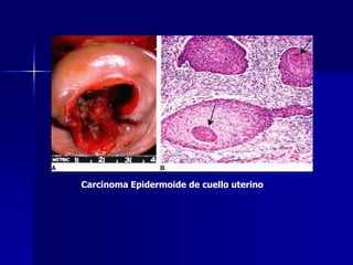 Carcinoma Epidermoide de cuello uterino
 