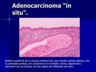 Adenocarcinoma "in
situ".
Epitelio superficial de la mucosa endocervical, que muestra células atípicas, con
su polaridad perdida, con variaciones en el tamaño, forma, disposición y
coloración de sus núcleos. No hay signos de infiltración del estro
 