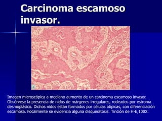 Carcinoma escamoso
invasor.
Imagen microscópica a mediano aumento de un carcinoma escamoso invasor.
Obsérvese la presencia de nidos de márgenes irregulares, rodeados por estroma
desmoplásico. Dichos nidos están formados por células atípicas, con diferenciación
escamosa. Focalmente se evidencia alguna disqueratosis. Tinción de H-E,100X.
 