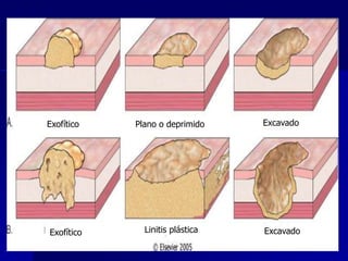 Exofítico Plano o deprimido Excavado
Exofítico Linitis plástica Excavado
 