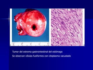 Tumor del estroma gastrointestinal del estómago
Se observan células fusiformes con citoplasma vacuolado
 
