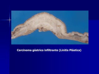 Carcinoma gástrico infiltrante (Linitis Plástica)
 