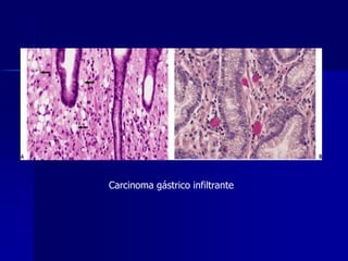 Carcinoma gástrico infiltrante
 