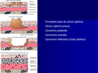 Principales tipos de cáncer gástrico
Cáncer gástrico precoz
Carcinoma polipoide
Carcinoma ulcerado
Carcinoma infiltrante (Linitis plástica)
 