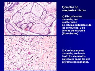 Ejemplos de
neoplasias mixtas
a) Fibroadenoma
mamario, con
proliferación
de células epiteliales (de
los conductos) y de
células del estroma
(fibroblastos).
b) Carcinosarcoma
mamario, en donde
tanto los elementos
epiteliales como los del
estroma son malignos.
 