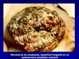 Necrosis de las neoplasias. Superficie fungante en un
cystosarcoma phyllodes mamario
 