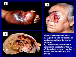 Superficie de las neoplasias
a) Superficie lisa y ulcerada en
un tumor maligno de células
gigantes.
b) Ulceración extensa en un
carcinoma basocelular facial.
c) Superficie vellosa o papilar en
un cistadenocarcinoma del
ovario
a b
c
 