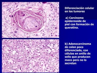 Diferenciación celular
en los tumores
a) Carcinoma
epidermoide de
piel con formación de
queratina.
b) Adenocarcinoma
de colon poco
diferenciado, con
células en anillo de
sello que producen
moco pero no lo
secretan
 