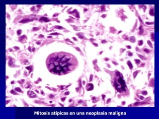 Mitosis atípicas en una neoplasia maligna
 