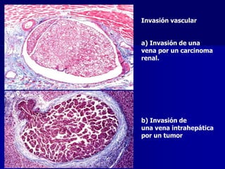 Invasión vascular
a) Invasión de una
vena por un carcinoma
renal.
b) Invasión de
una vena intrahepática
por un tumor
 