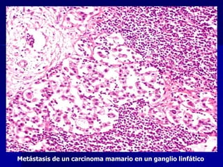 Metástasis de un carcinoma mamario en un ganglio linfático
 