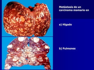 Metástasis de un
carcinoma mamario en
a) Hígado
b) Pulmones
 