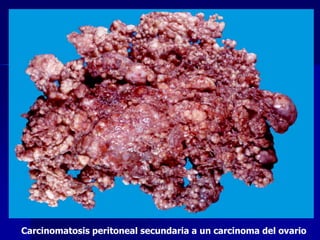 Carcinomatosis peritoneal secundaria a un carcinoma del ovario
 