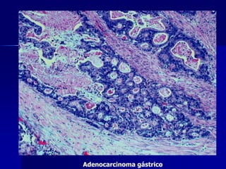 Adenocarcinoma gástrico
 