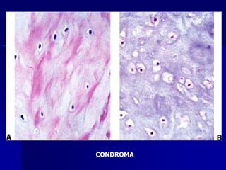 CONDROMA
 