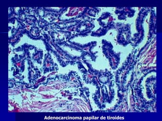 Adenocarcinoma papilar de tiroides
 