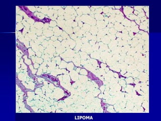 LIPOMA
 