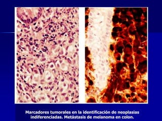 Marcadores tumorales en la identificación de neoplasias
indiferenciadas. Metástasis de melanoma en colon.
 