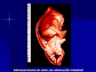 Adenocarcinoma de colon con obstrucción intestinal
 