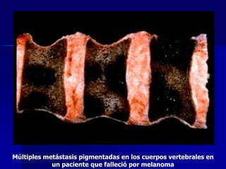 Múltiples metástasis pigmentadas en los cuerpos vertebrales en
un paciente que falleció por melanoma
 