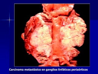 Carcinoma metastásico en ganglios linfáticos periaórticos
 