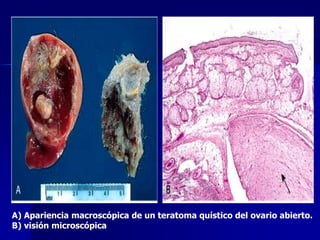A) Apariencia macroscópica de un teratoma quístico del ovario abierto.
B) visión microscópica
 