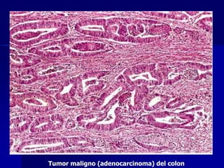 Tumor maligno (adenocarcinoma) del colon
 