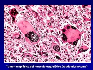 Tumor anaplásico del músculo esquelético (rabdomiosarcoma)
 