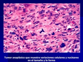 Tumor anaplásico que muestra variaciones celulares y nucleares
en el tamaño y la forma
 