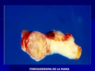 FIBROADENOMA DE LA MAMA
 